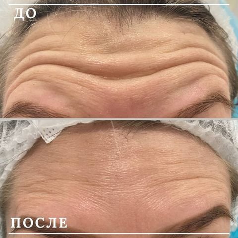 Ботулинотерапия лба