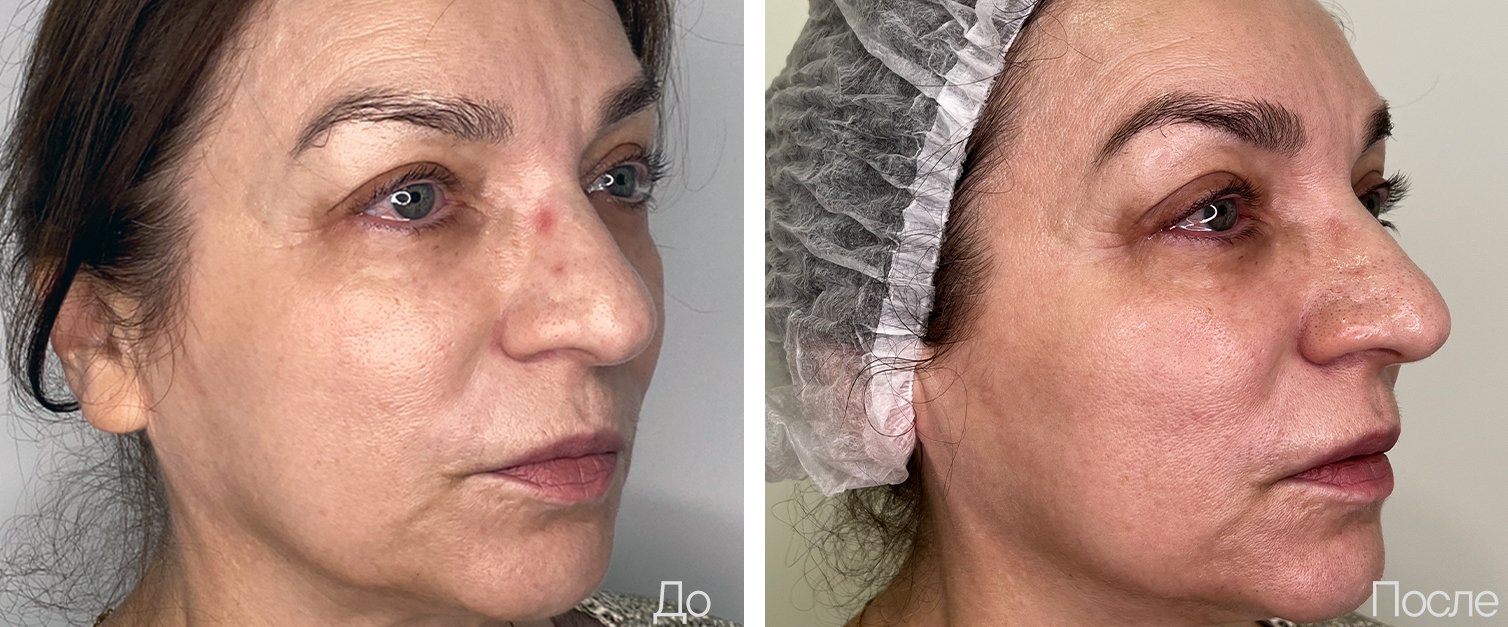 Контурная пластика